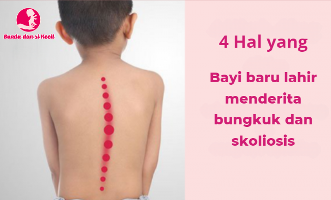 4 Kebiasaan Yang Dapat Membuat Bayi Bungkuk & Skoliosis Saat Besar Nanti
